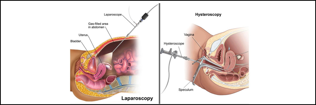 Laparoscopy And Hysteroscopy